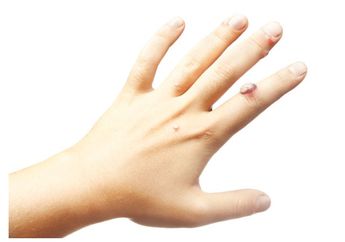 Singkirkan Kutil dengan Bahan Alami Berikut Ini, Biar Kulit Makin Mulus