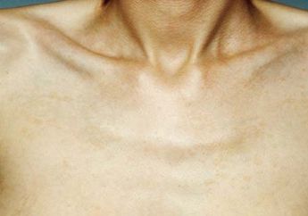 Berat Badan Turun Tanpa Olahraga Atau Diet? Lihat Penyebabnya di Sini