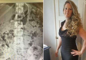 Wanita ini Tiap Hari Muntahkan Tinja, Dokter Kaget Begitu Lihat Hasil Rontgen