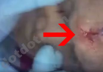 Ngeri! Ternyata Begini Saat Susuk Dikeluarkan Dari Tubuh Manusia, Lihat Videonya