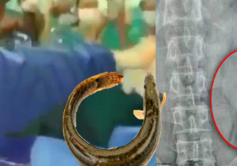 Akibat Seks Menyimpang, Dua Ekor Ikan Terperangkap Dalam Dubur Pria Ini, Peristiwa Selanjutnya Sangat Mengerikan