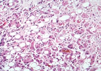 Hari Ini Peringatan Hepatitis Sedunia