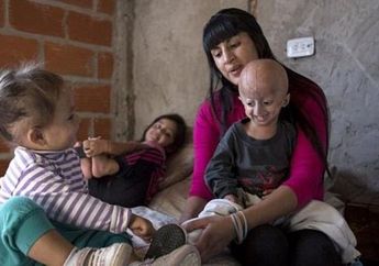 Progeria, Kelainan Genetis yang Sebabkan Anak Jadi Tua