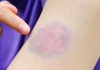 6 Penyebab Timbul Memar di Tubuh Secara Tiba-Tiba