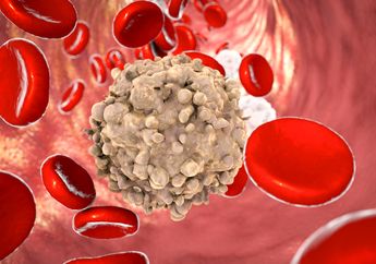 6 Tanda Leukemia yang Harus Anda Waspadai