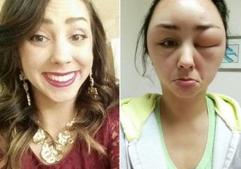 Duh! Wajah Perempuan Ini Bengkak karena Alergi Pewarna Rambut