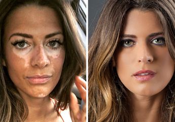 Di Balik Wajah Mulus Cantiknya, Model Cantik Ini Menderita Vitiligo