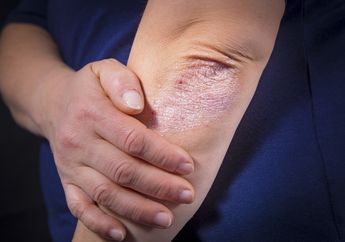 Istri Caisar “YKS” Terserang Psoriasis, Penyakit Apa Itu?