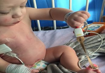 Orangtua Bayi 14 Bulan Penderita Kanker Mata Ini Galang Dana