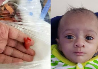 Perjuangan Hidup Manushi, Bayi Pematur yang Terlahir Sebesar Sebatang Coklat