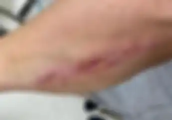 Ngilu, Video Kondisi Lengan Cal Crutchlow Yang Dilarang Membalap Oleh tim Medis MotoGP San Marino 2020