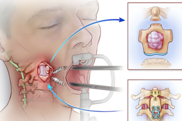Ilustrasi proses pengangkatan tumor chordoma dengan bantuan TROS.