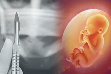 Ilustrasi Aborsi