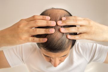 Garis Rambut di Sekitar Dahi Mundur, Tanda Anda Mengalami Kebotakan