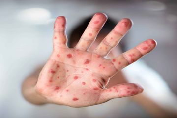 Penting! Ternyata Inilah Cara Cegah Terjangkit Virus Cacar Monyet