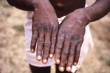 Penyakit cacar monyet atau monkeypox