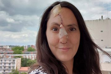 Terkena Kanker Kulit, Hidung Perempuan Ini Bolong karena Tak Pernah Pakai Tabir Surya