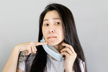 4 Penyebab Paling Umum yang Bikin Timbulnya Jerawat Setelah Memakai Masker