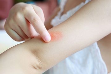 Ampuh! Pakai Bahan Alami Sebagai Cara Menghilangkan Bekas Gigitan Nyamuk Menggelap