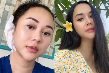 Tulangnya Dibor karena Jalani Operasi Telinga, Aura Kasih Beberkan Kondisinya Saat Ini: Doain ya