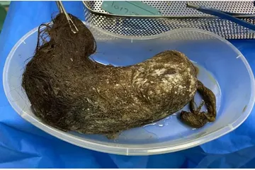 Gumpalan rambut yang ditemukan di dalam perut seorang remaja di Inggris.