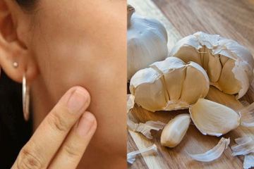 Nggak Usah Beli Salep, Panu Ternyata Bisa Hilang Hanya dengan Bawang Putih, Dijamin Badan Bebas Gatal Selamanya!