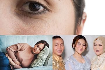 Berita Terpopuler: Cara Menghilangkan Milia Cuma Modal Air Hangat hingga Cara Menghilangkan Asam Lambung Pakai Baking Soda