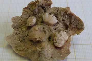 Penampakan tumor ovarium yang mulai tumbuh gigi telah ditemukan arkeolog ketika menggali kuburan Gereja dan Biara Carmon di Lisbon, Portugal.