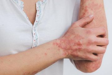 Perbedaan Cacar Air dan Cacar Monyet, Mulai dari Gejala Hingga Masa Inkubasi Virus