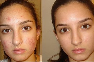 Gak Sanggup Beli Skincare, Wanita ini Nekat Campurkan Baking Soda dan Minyak ini Lalu Oles ke Wajah, Hasilnya Malah Bikin Tercengang!