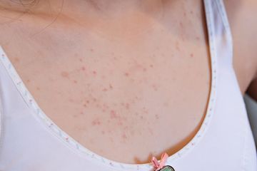 Pasti Malu Kalau Ketahuan Apalagi Dilihat Suami, Segera Atasi Jerawat di Payudara dengan Cara ini, Dimulai dari Bra
