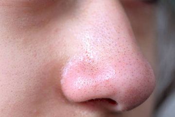Komedo Gak Bakal Muncul Lagi, Cuma Modal Oleskan 1 Bahan Ini ke Hidung, Kulit Pasti Jadi Mulus dan Bersih