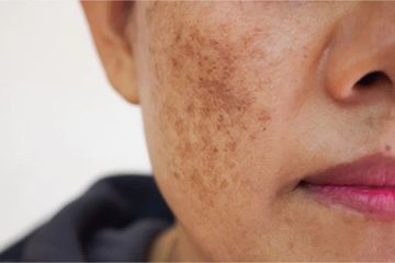 Kapok Skincare Mahal Tapi Gak Ada Hasil, Flek Hitam Hilang Sampai ke Akar Cuma Pakai Masker Bengkuang, Cara Buatnya Gampang Banget