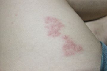 Auto Mulus! Cara Menghilangkan Bekas Herpes yang Menghitam dengan Bahan Alami di Rumah