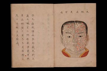 Ilustrasi cacar Jepang berasal dari tahun 1720, dari sebuah karya berjudul  The essentials of Smallpox. Epidemi cacar ini menjadi catatan sejarah Jepang yang hampir menghancurkan negara.