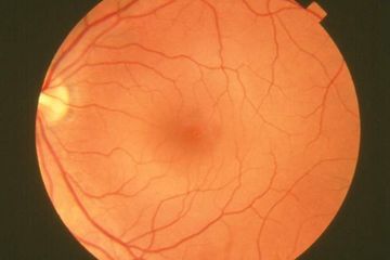 Pupil Mata Berubah Putih? Waspada Kanker Retina
