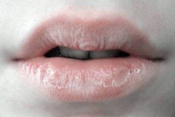 Bila bibir kering tersebut dibiarkan, maka kekeringan akan bertambah parah dan dapat menyebabkan kel