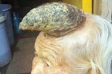 Kondisi Langka, Tumbuh &lt;i&gt;Tanduk&lt;/i&gt; di Kepala Nenek Ini