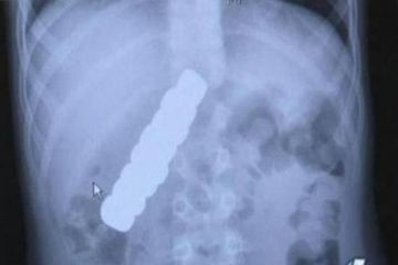 Dikira Flu Perut, Ternyata Ada 8 Potong Magnet di Usus Bocah Ini