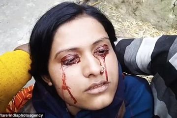 Geeta, wanita asal India, yang mengidap hematidrosis.
