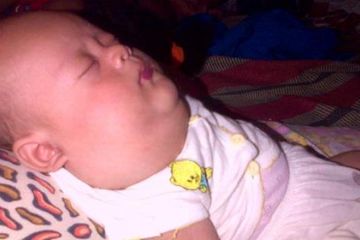 Derita Bayi Pengidap Tumor di Pengungsian