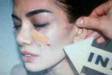 Nikita Mirzani Dianiaya Tubuhnya Penuh Luka