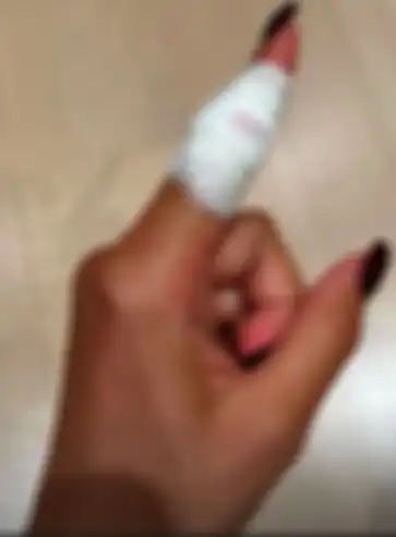 Jari Zendaya yang terluka akibat masak