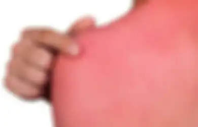 Kulit Terbakar Sinar Matahari? Redakan dengan 5 Bahan Alami Ini