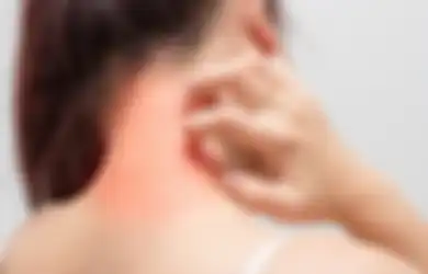 Gatal-gatal Akibat Alergi? Atasi dengan 7 Bahan Alami Ini, Deh!