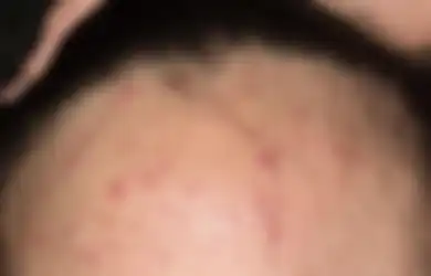 Enggak Sembarangan, Gini Lho Cara Mengatasi Fungal Acne yang Benar!