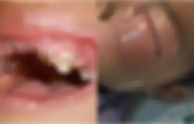 Sering Makan Permen dan Jarang Sikat Gigi, Bocah 3 Tahun Ini Alami Kondisi Mengerikan dan Nyaris Meninggal