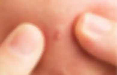 Bikin Parah, 5 Kandungan Skincare Ini Wajib Dihindari Saat Jerawatan!