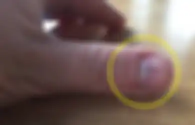 Garis Hitam Pada Kuku Bisa Jadi Tanda Adanya Penyakit Mematikan
