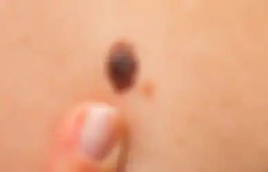 Waspada! 5 Hal Ini Menjadi Pertanda Jika Tahi Lalat yang Ada di Tubuh adalah Kanker